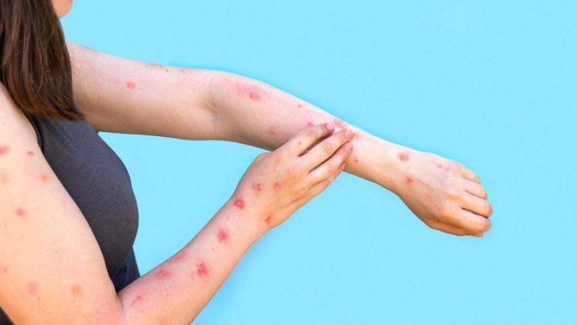 Eine Frau mit Ausschlag auf den Armen kratzt sich.