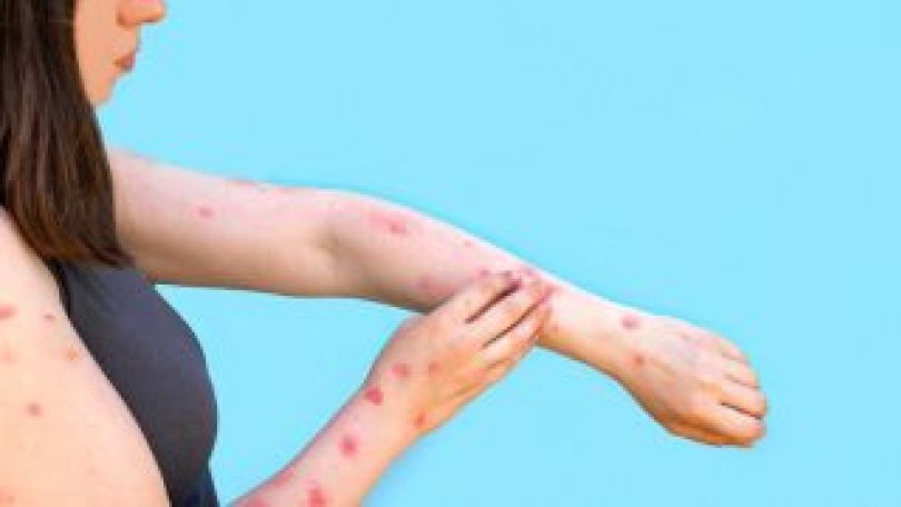 copyright: iStock Woman scratches her hands with rash, red spots blisters. Monkeypox new disease dangerous over the world. Patient with Monkey Pox. Close up rash, human with Health problem. Copy space.